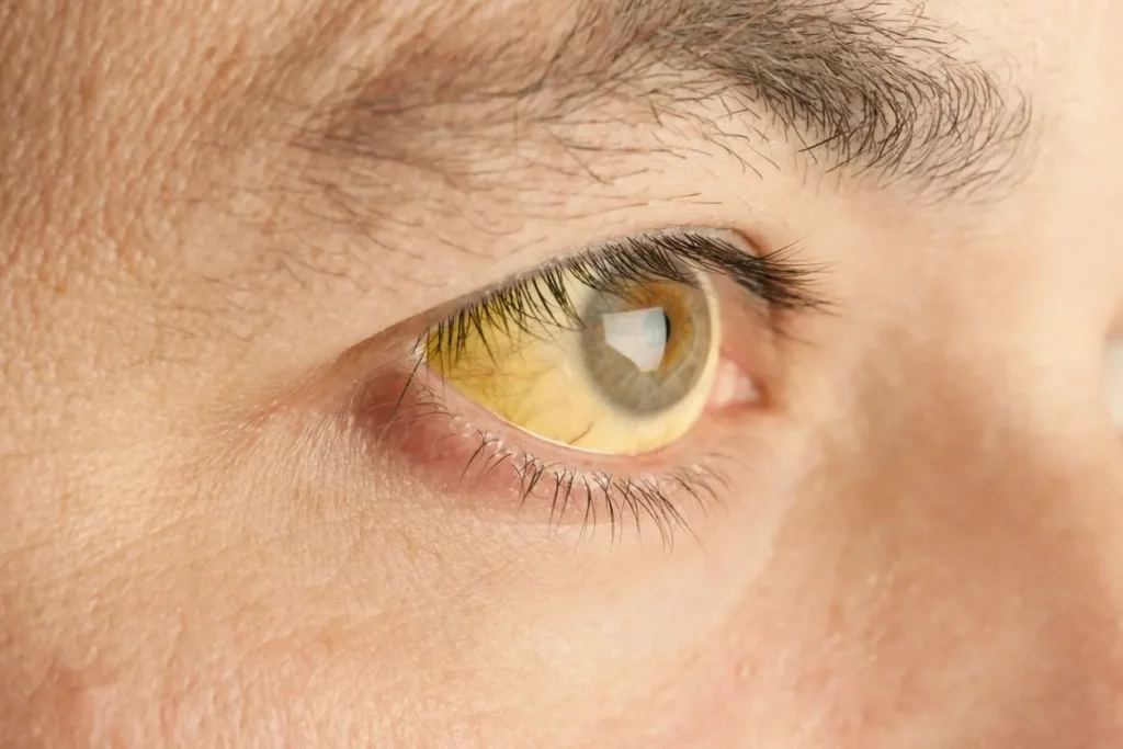 Why Mixing Prednisolone and Alcohol Is Unsafe. Jaundice eyes
